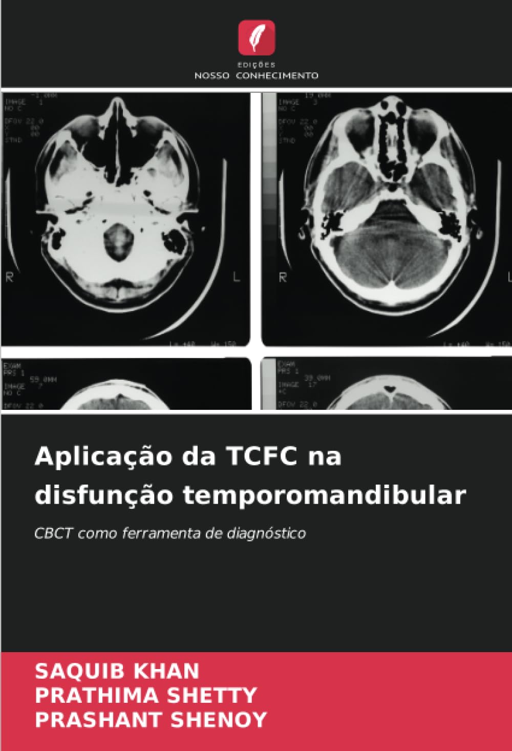 Aplicação da TCFC na disfunção temporomandibular: CBCT como ferramenta de diagnóstico (Portuguese Edition)