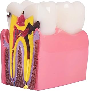 Dental Caries Teeth Model, Dental Model, 6 Times Caries Teaching Typodont Tool for Dentists, Patients, Teachers and Students.