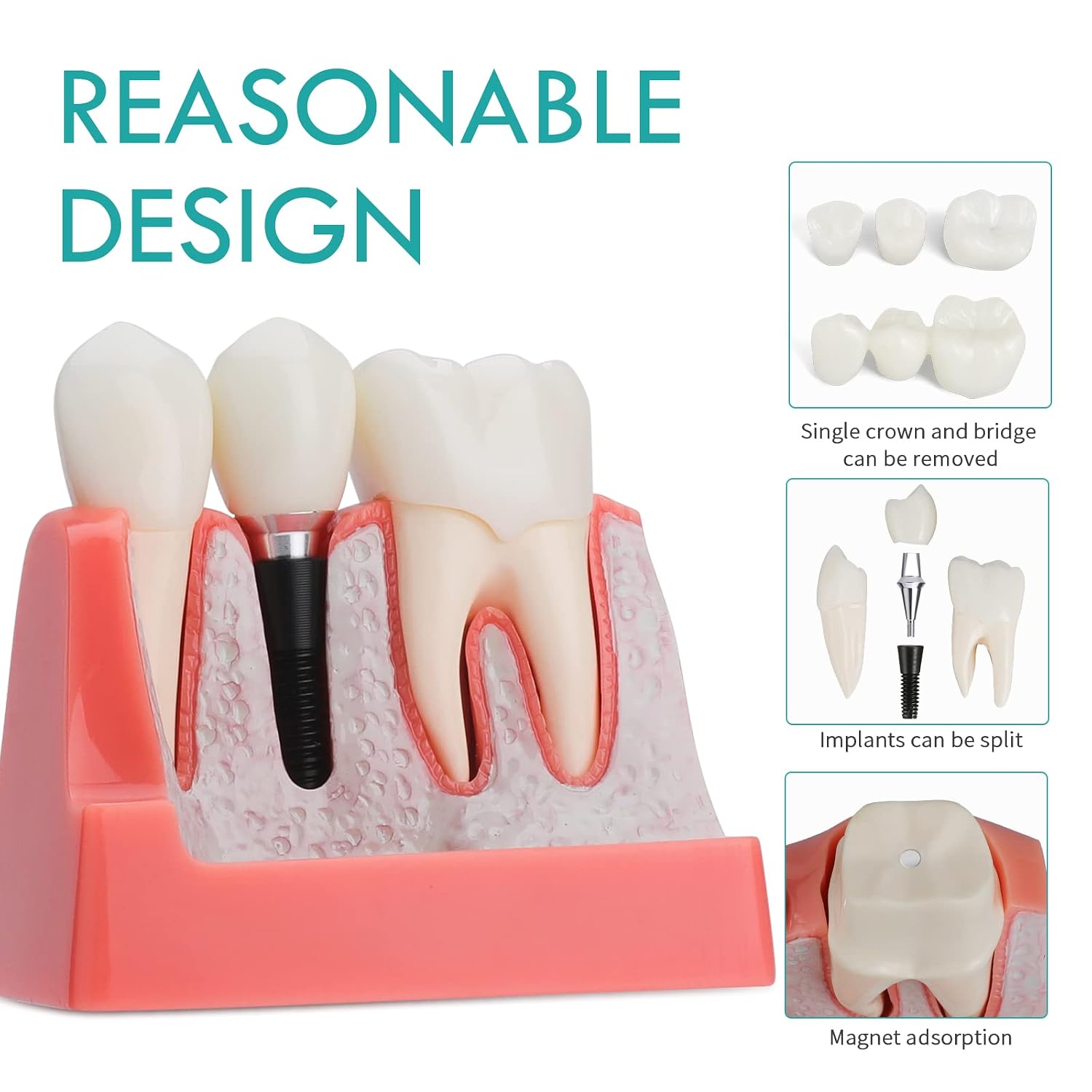 Dental Implant Model - 4 Times Crown Bridge Explanation Model Implant Analysis Tooth Model Removable Crown Cross-Section Demonstration for Study and Teaching