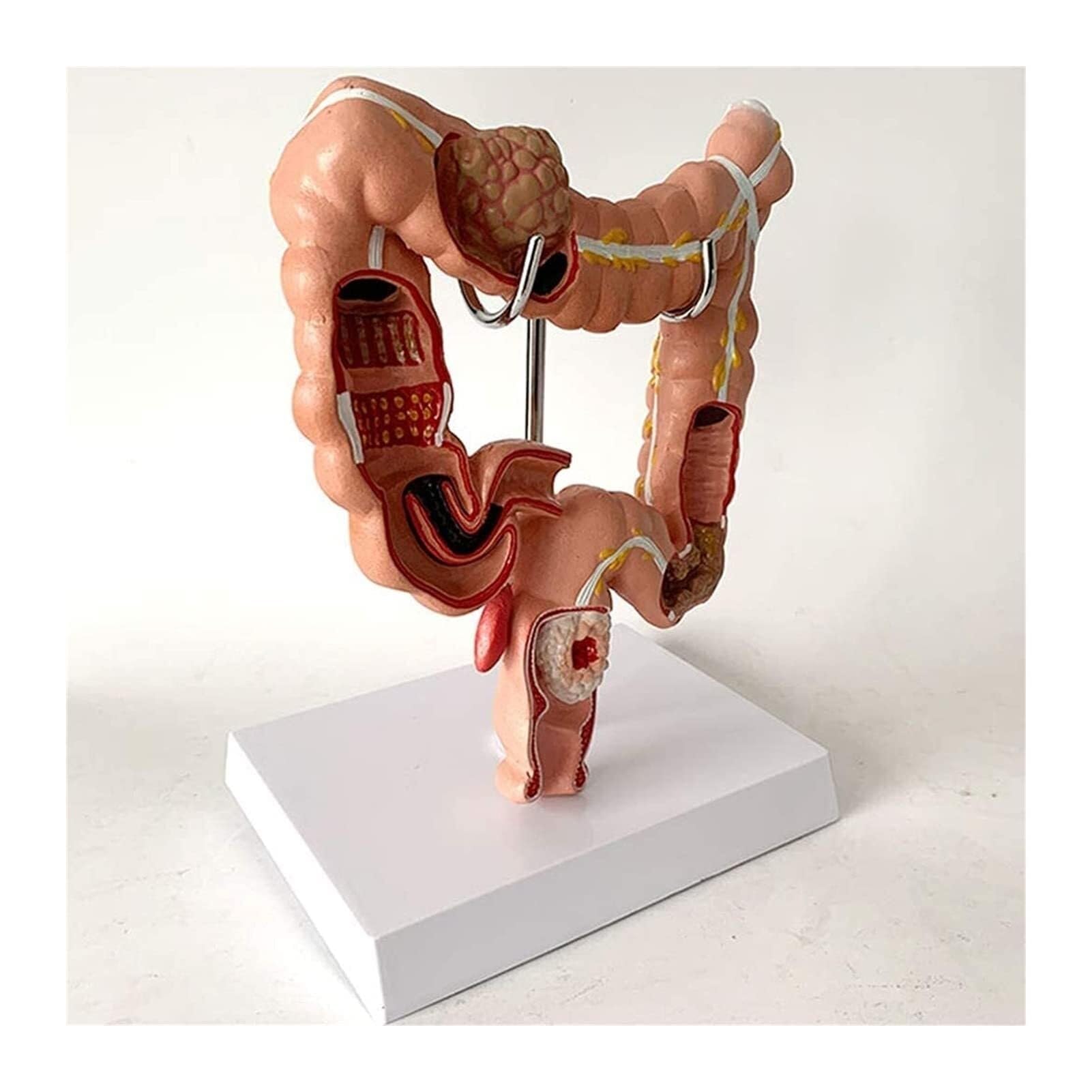 XINGLUOY Colon Pathology Model Human Large Intestine Anatomy