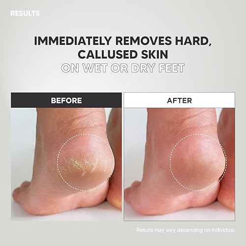 Miniatura 5 de Esmeril ancho, herramienta de pedicura de doble cara, lima de pie colosal para hombres y mujeres, eficaz para talón agrietado, removedor de callos,