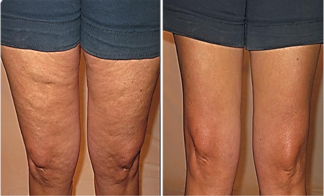 Buy Skinnies Instant Lifts 5 Pair Thigh Lifts PATENTED MADE IN THE