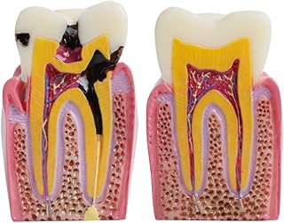 Dental Teeth Model Caries Tooth Model Patient Education 6 Times Caries Two-Side Comparation Study Model Standard Pathological Tooth Teaching Tools