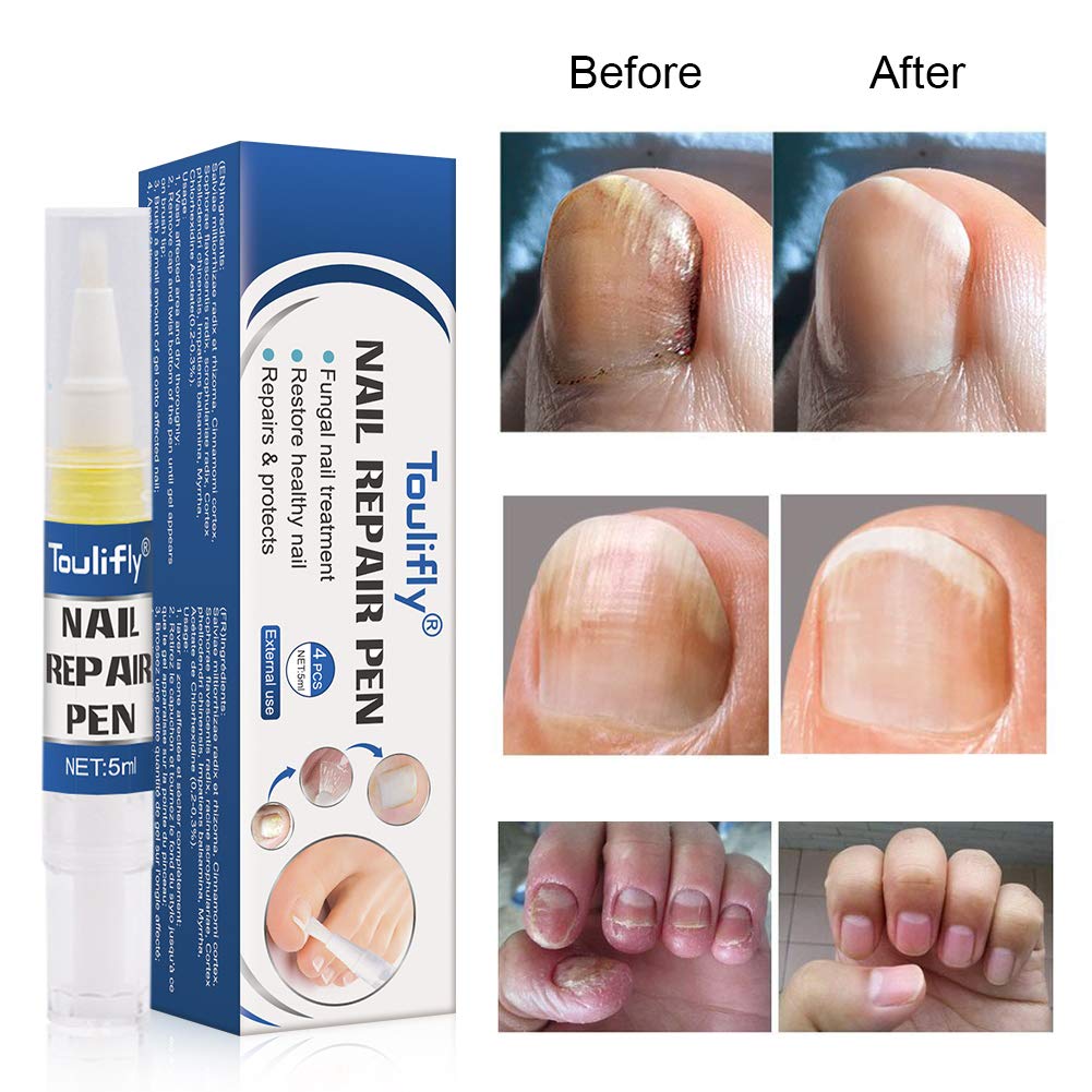 Nail Fungus Treatment, Fungus Stop,Toe Nail Fungus Treatment, Anti