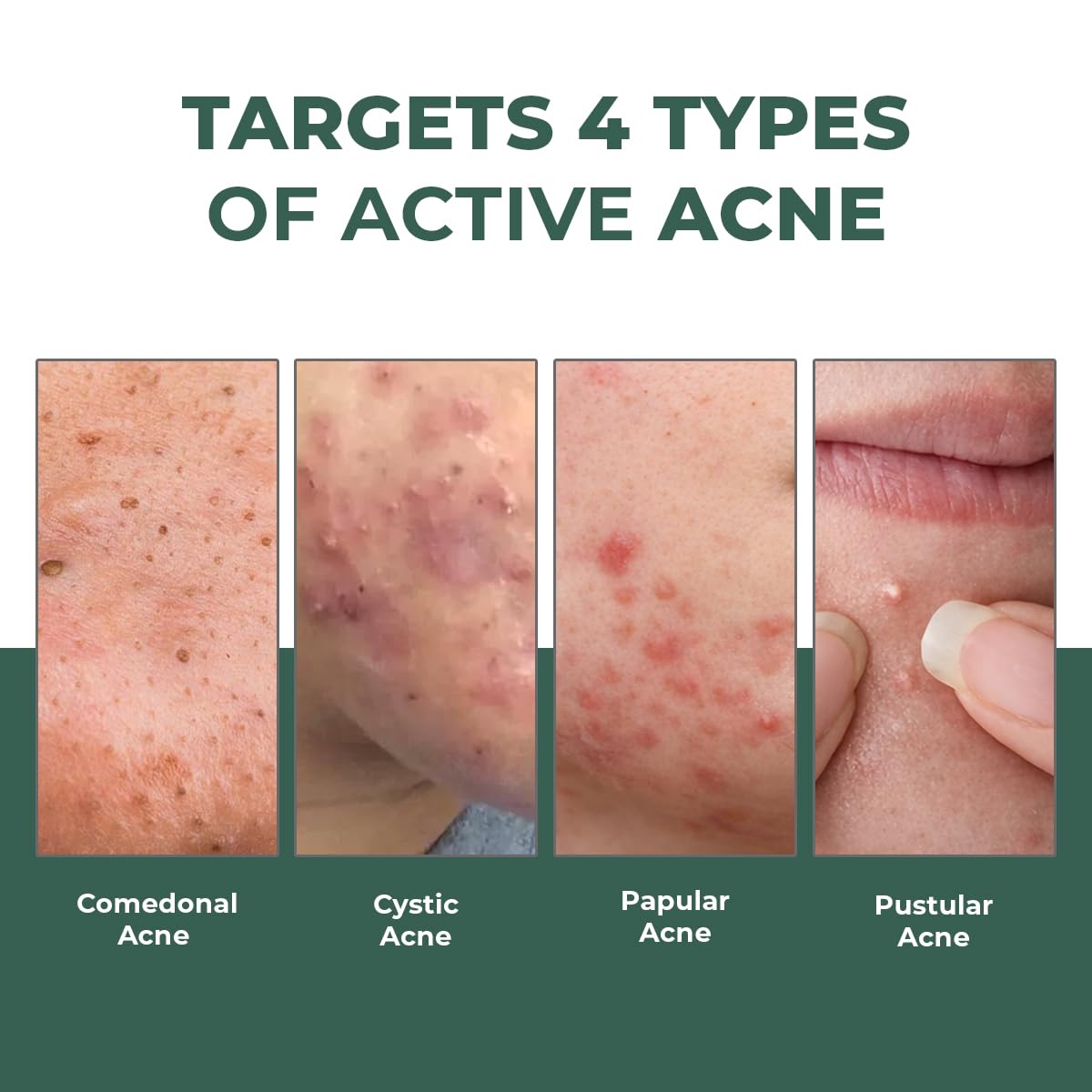 Conscious Chemist® Rapid Relief Acne Spot Corrector Gel 15g | 2% Salicylic Acid & Azelaic Acid Acne Spot Treatment | Pimple Removal Gel for Active Acne, Redness & Dark Spots | Fast-Acting Spot Corrector for Men & Women 2