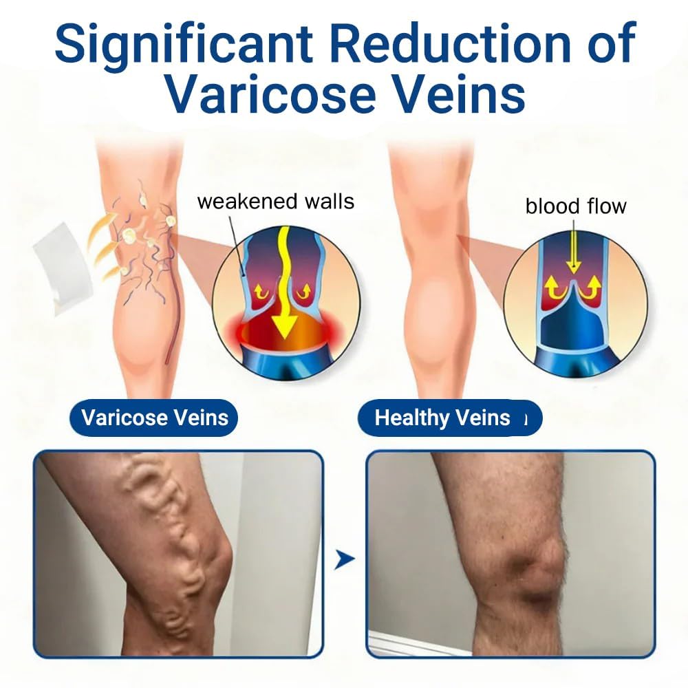 Cerotto a microaghi VeinTarget, 2026 Trattamento avanzato per le vene varicose delle gambe, cerotto per le vene, trattamento naturale per le gambe adatto a tutti i tipi di pelle (2pcs)