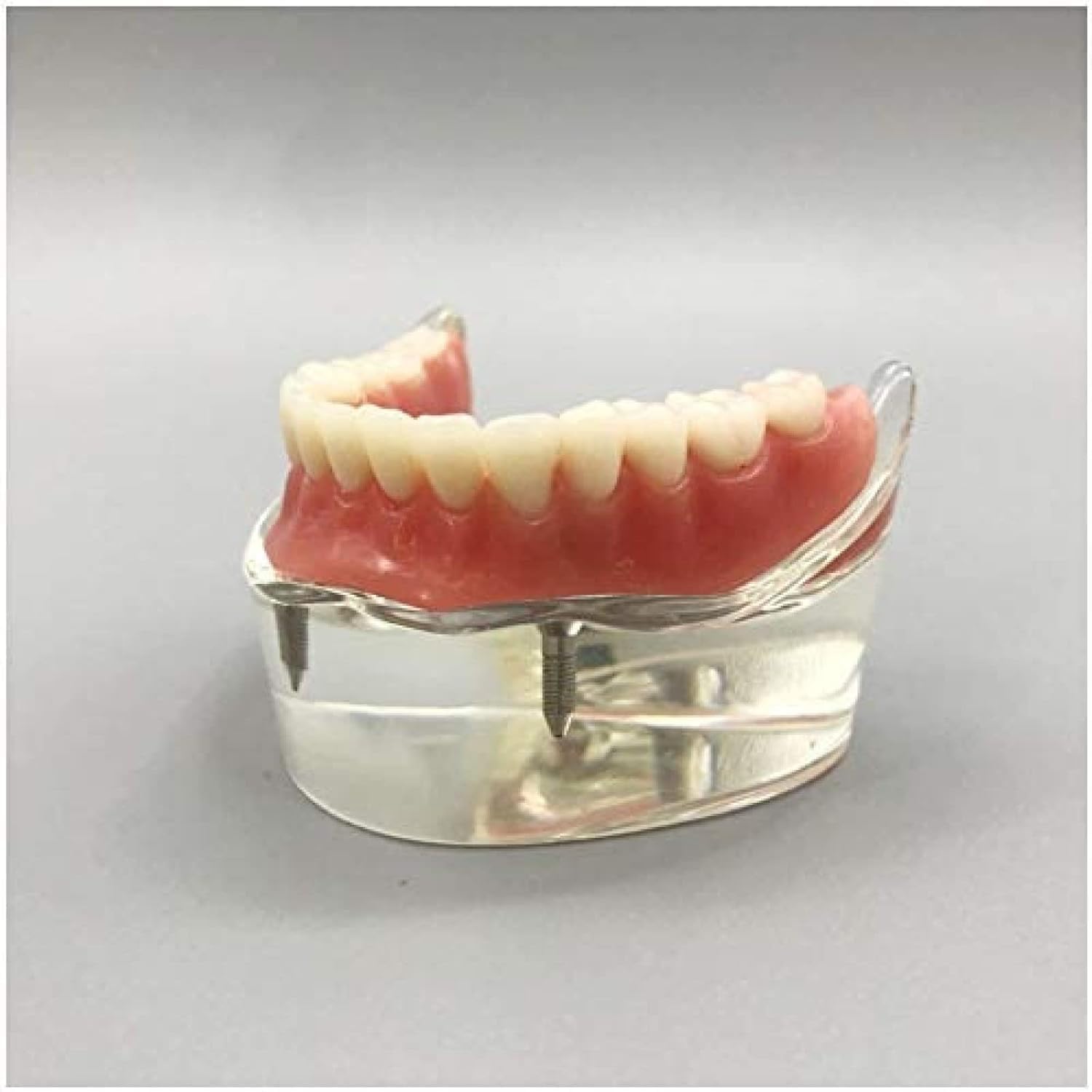 Modello Dentale - Impianto Dentale - Overdenture Inferiore Mandibolare 2 Impianti Demo Per L'insegnamento E Lo Studio