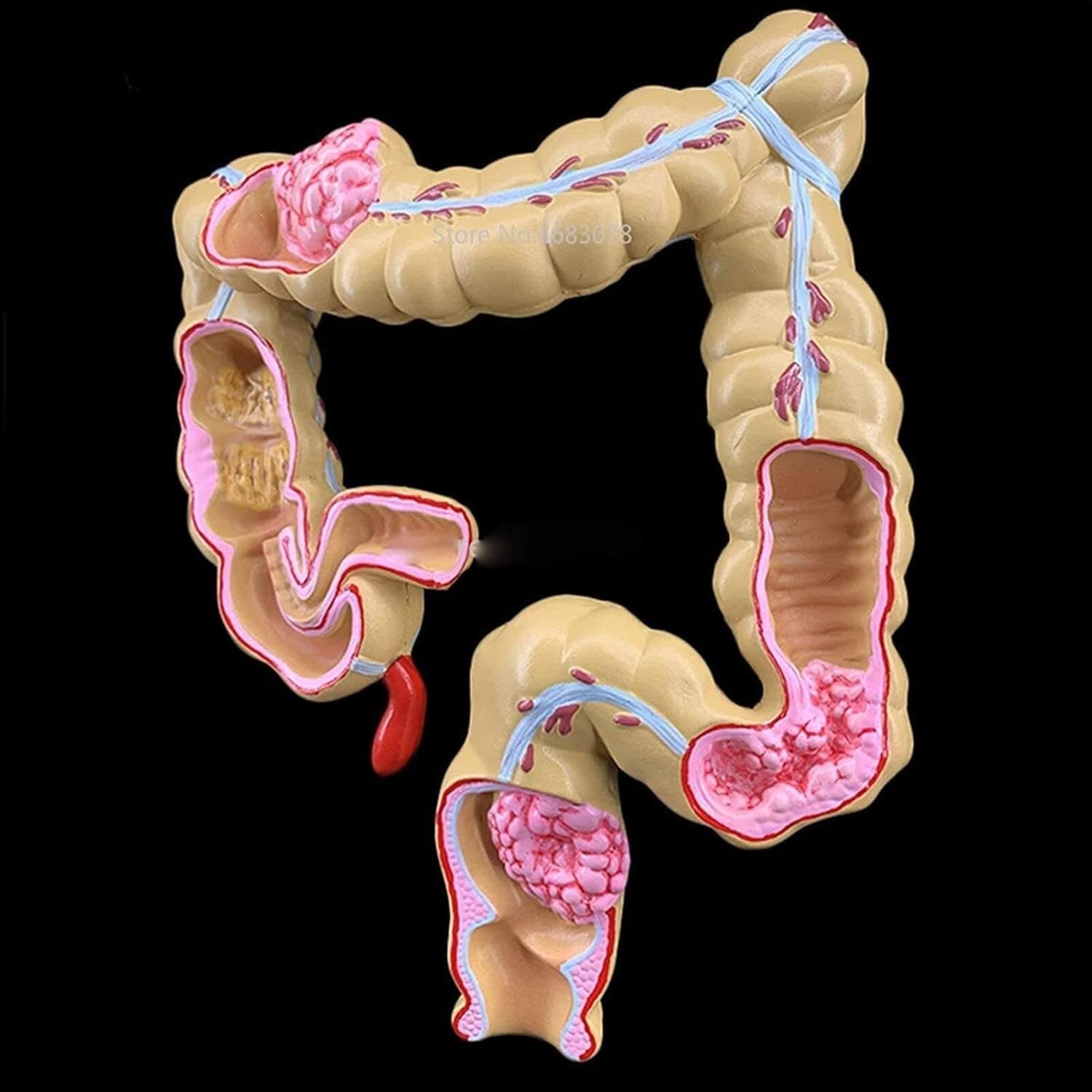 YNIYUJKL Human Large Colon Pathological Lesion Model,1 Colorectal Lesion Medical Tissue, Human Digestive System Anatomy Model For Medical Learning And Physiology Education