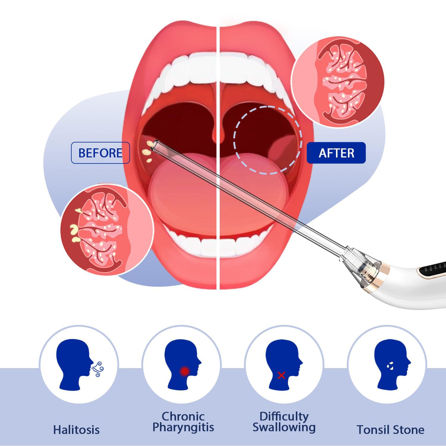Oral Icon Kit Elettrica di Rimozione Calcoli Tonsillari - Pipetta di Aspirazione a Vuoto - Kit Completo - Alito Più Fresco - Specchio d'Ingrandimento 5X, Depressore Linguale e Siringa Irrigatrice