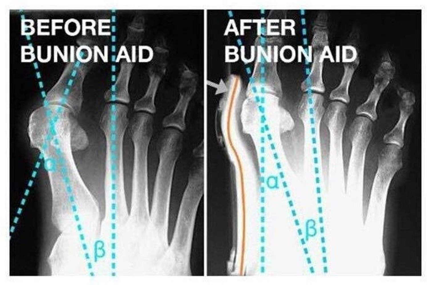 Hallux-Valgus-Korrektor, Zehenspreizer, weich, atmungsaktiv, Ballen-Korrektor, Ballen-Entlastung, Schiene für große Zehen, verhindert Hallux Valgus und nächtliche Schmerzlinderung (rechter Fuß)