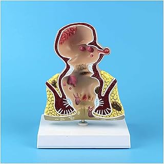 Study Model Pathological Model of Hemorrhoids Anorectal Teaching Anatomy Model - Human Organ Anatomical Model Anorectal Pathology Model - Doctor-Patient Communication and Explanation Teaching Model