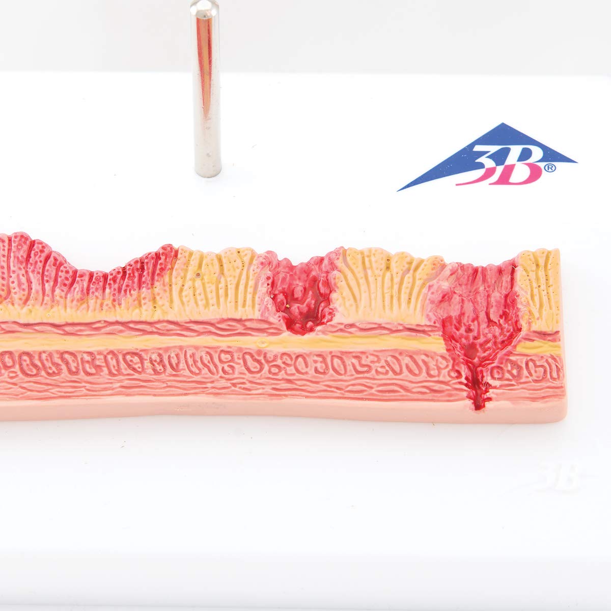 3B Scientific K17 Stomaco con Ulcere Gastriche + software gratuito di anatomia - 3B Smart Anatomy