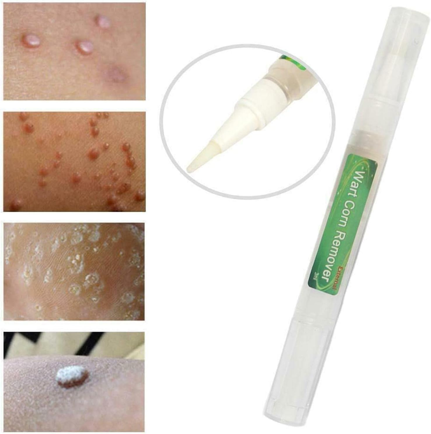 5Pcs Genital Wart ​Treatment Papillomas Removal Warts Liquid Remove Fast Effective Wart Remover Pen 3ml