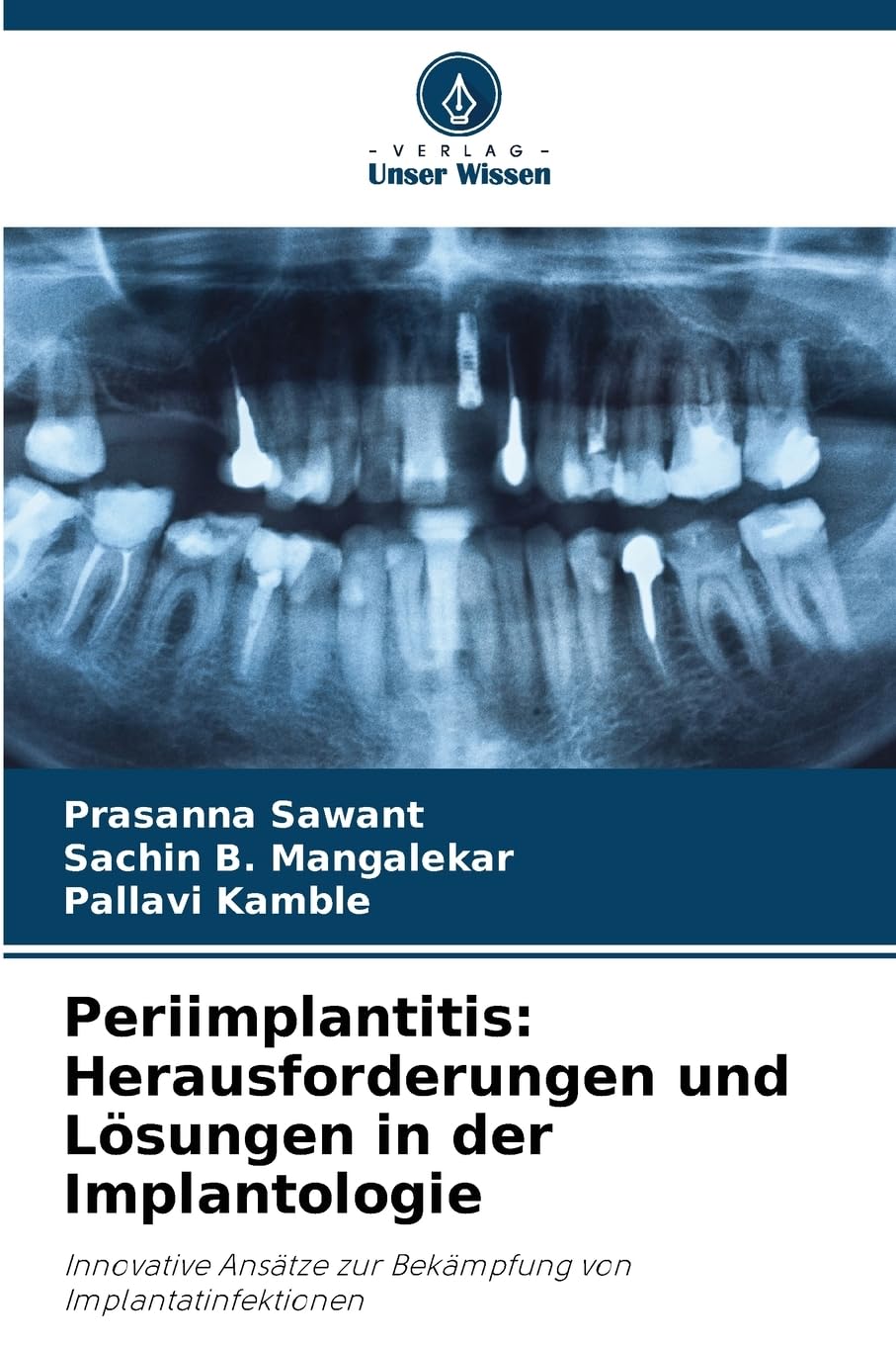 Periimplantitis: Herausforderungen und Lösungen in der Implantologie: Innovative Ansätze zur Bekämpfung von Implantatinfektionen