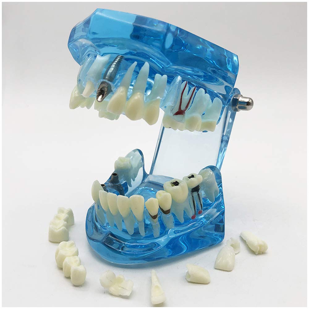 Modello di Denti da 2 Pezzi, Modello di Analisi di Studio di Impianti Dentali per Riparazione di Carie Dentale, Modello Dimostrativo per L'Insegnamento Medico, Forniture di Laboratorio
