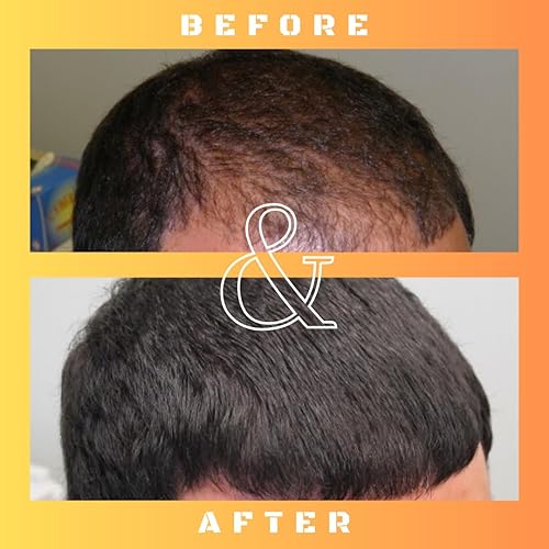 Miniatura 4 de RU58841 Solución al 5% (50 mgml) - Bloqueador DHT - Tratamiento avanzado para la pérdida de cabello - Tónico capilar anti-andrógeno - Promueve el