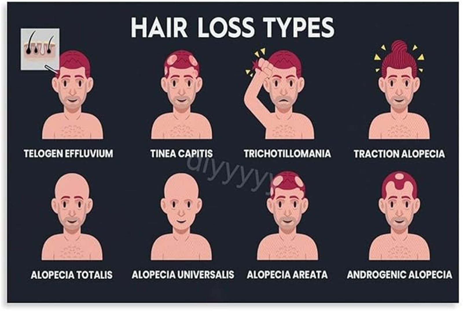 XGINERFEX Hair Loss Types Diagram Informative Canvas Poster for Home Library Decor(Framed,12x18inch(30x45cm))
