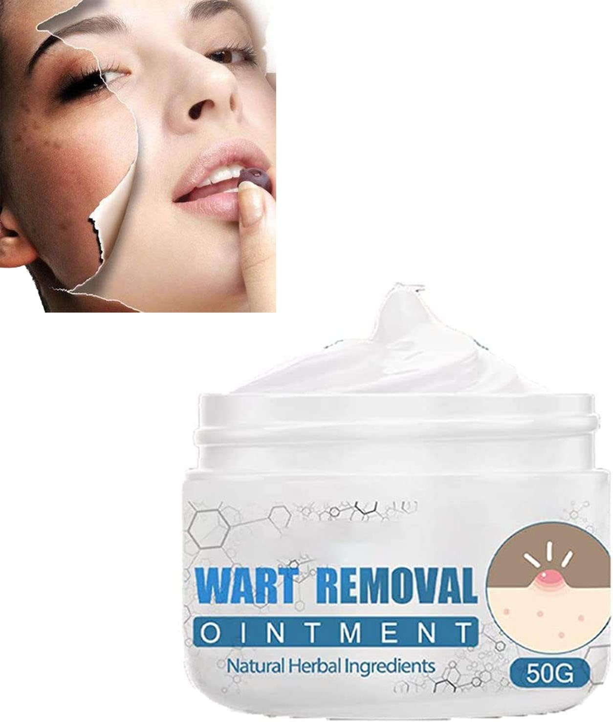 Petechiae Removal Cream,Remove Warts Paste,Keloid Bump