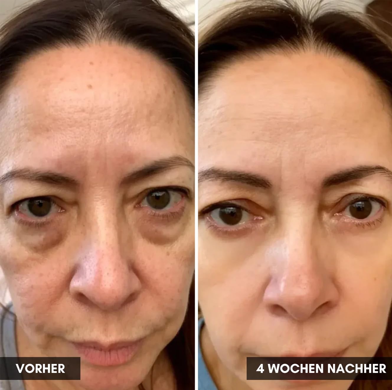 Invisla Lumin Eye, 2-in-1 Technologie Gegen Tränensäcke, Augenringe