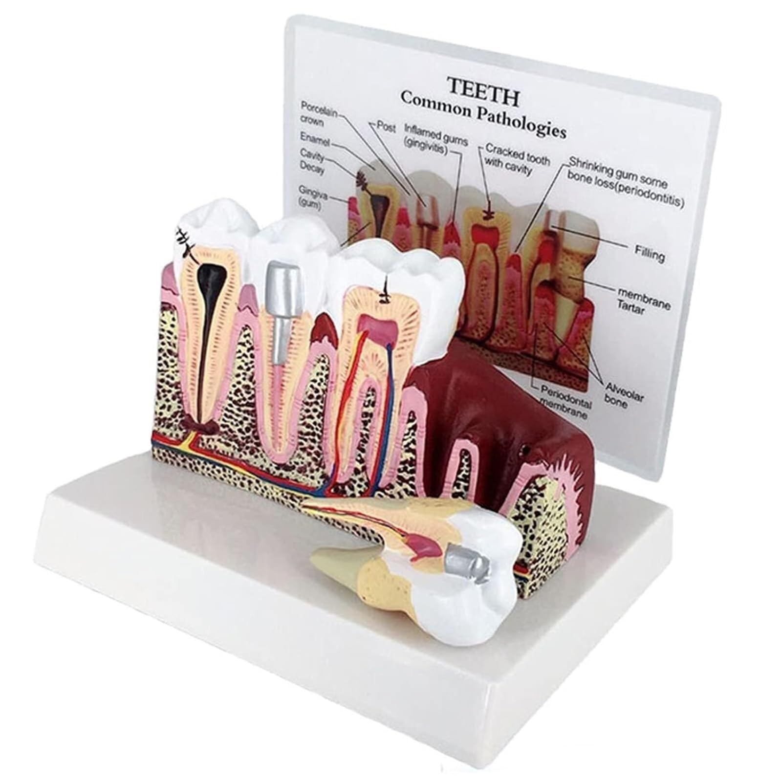 Modèle de dents d'éducation en anatomie dentaire – Modèle de section transversale des dents avec gencives dentaires amovibles pour affichage de pathologie, parfait pour les étudiants et les