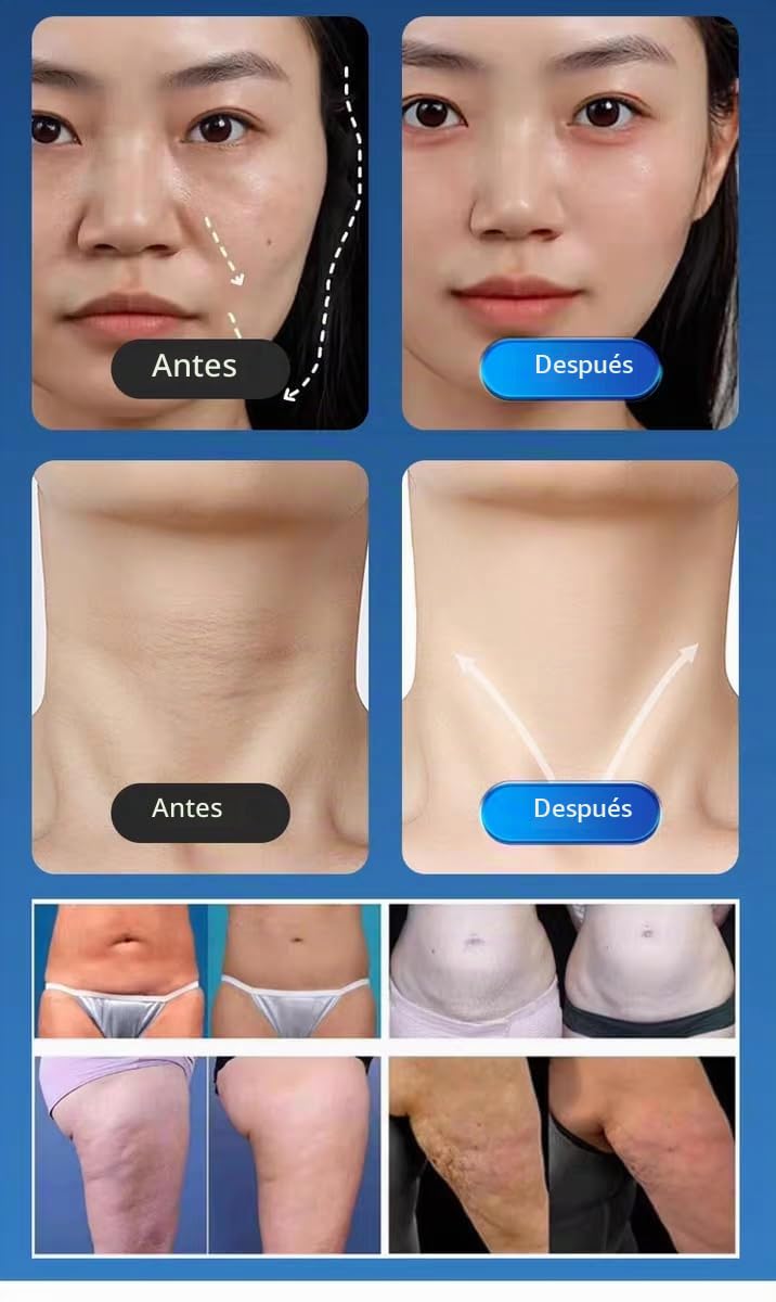 Dispositivo Profesional Antienvejecimiento 3 en 1 de Radiofrecuencia Fraccionada con Microagujas Lifting Facial Reducción de Arrugas Poros y Flacidez Rejuvenecimiento de la Piel