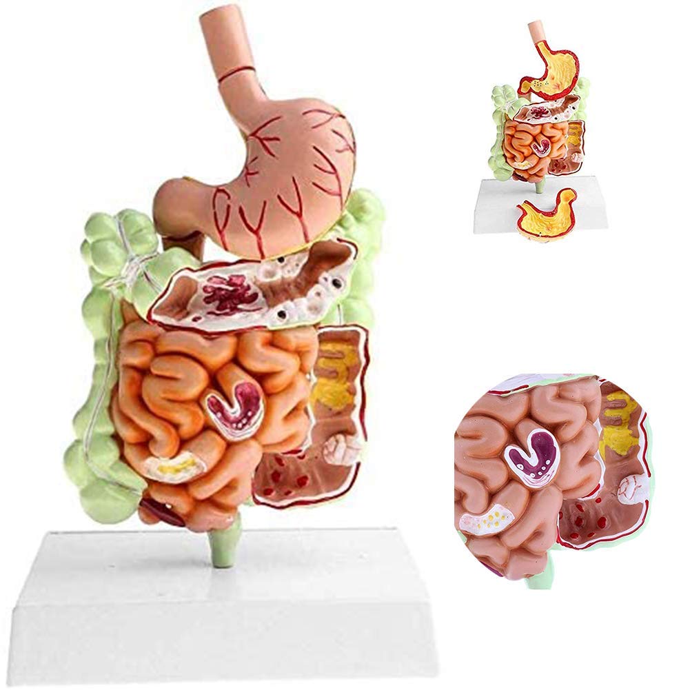 oBlosdh Human Colonic Disease Model-Large Intestine Pathological Model-Gastrointestinal Model-For Scientific Research and Doctor-Patient Communication