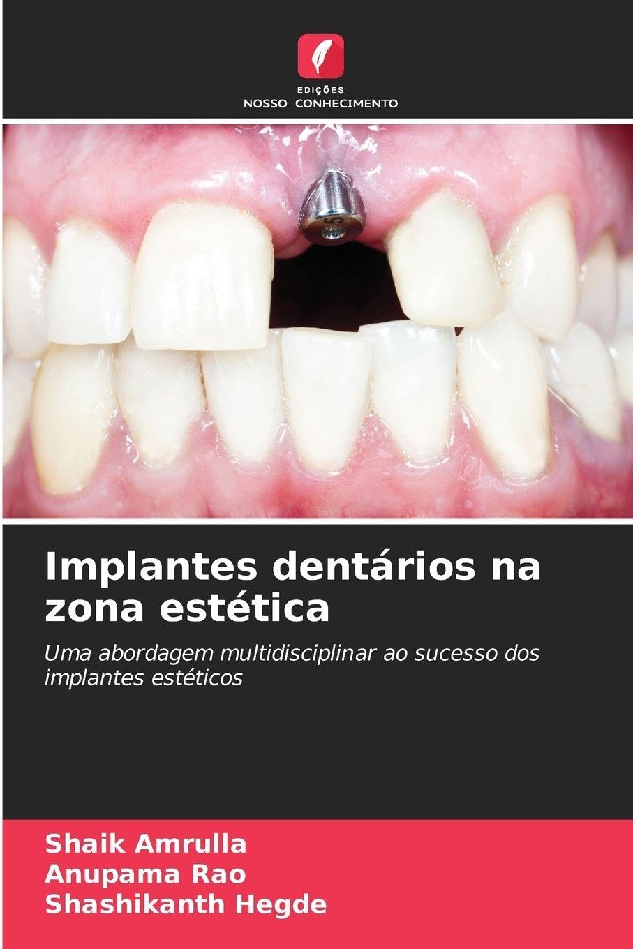 Implantes dentários na zona estética: Uma abordagem multidisciplinar ao sucesso dos implantes estéticos