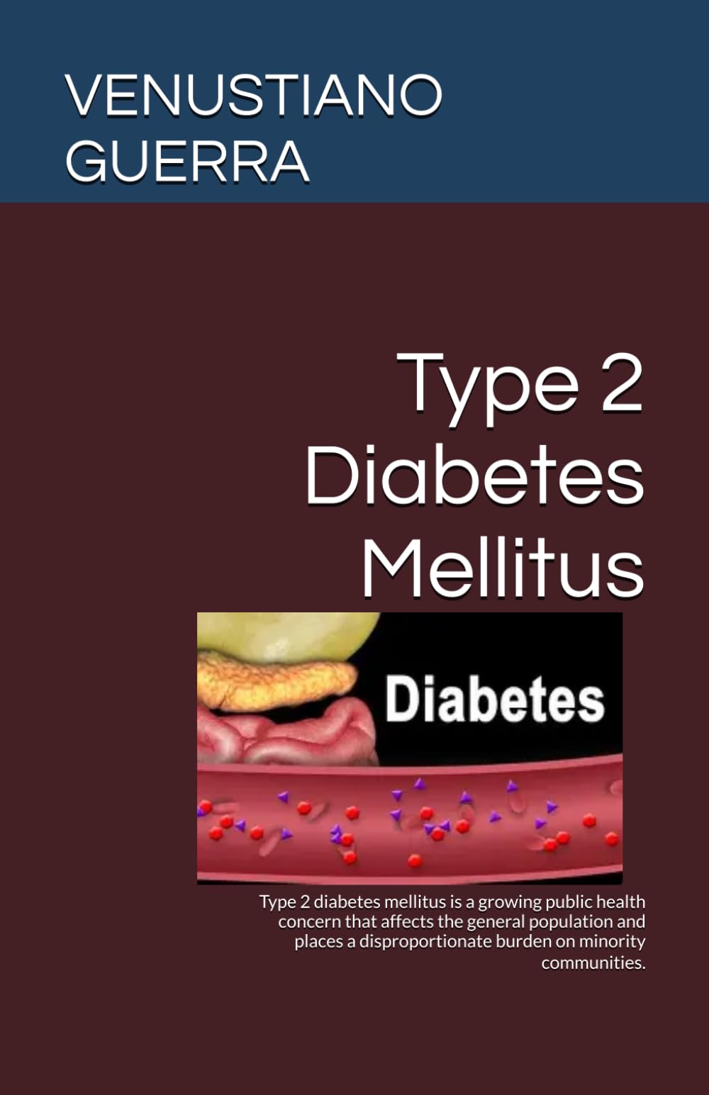 Type 2 Diabetes Mellitus: Type 2 diabetes mellitus is a growing public health concern that affects the general population and places a ... (Medical Publications for lay people)