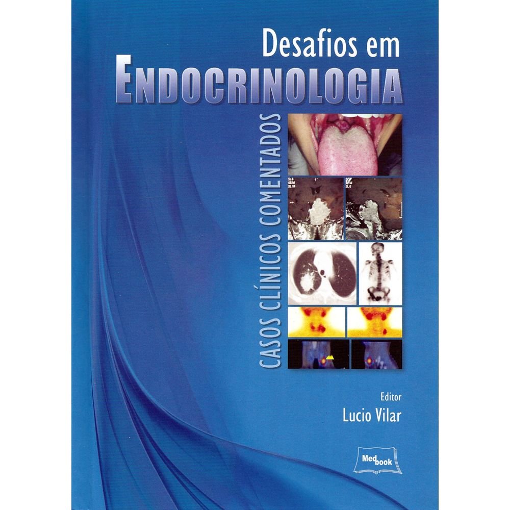 Desafios em Endocrinologia. Casos Clínicos Comentados (Em Portuguese do Brasil)
