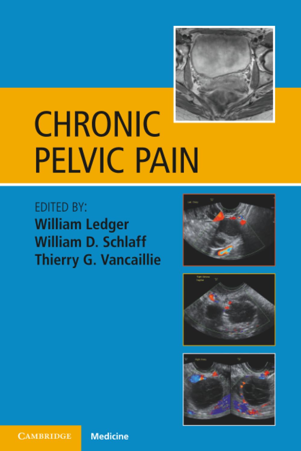 Chronic Pelvic Pain