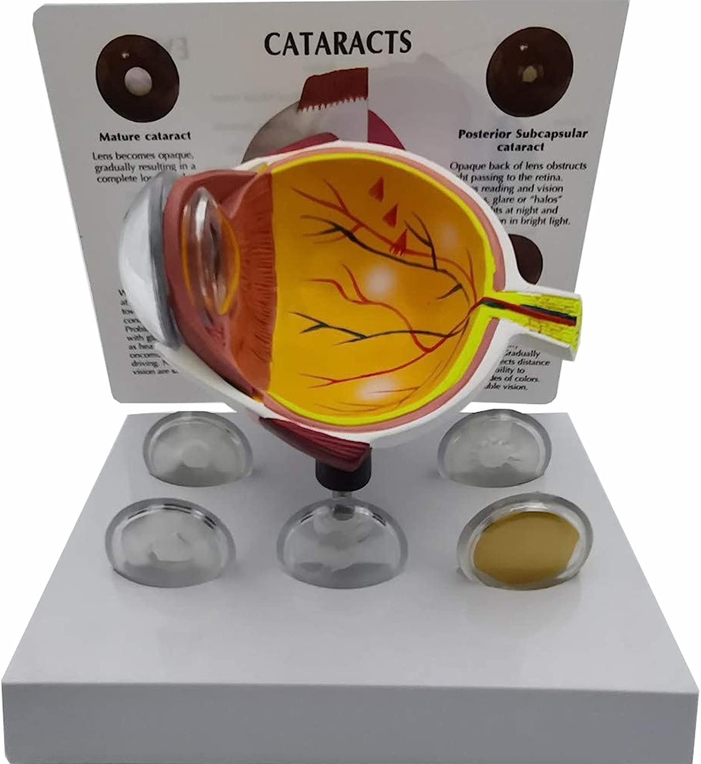 Human Eye Anatomical Model Eye Anatomy Model, Cataract Eye Model with Removable Stand for Science Education Students Study Display Medical Teaching.
