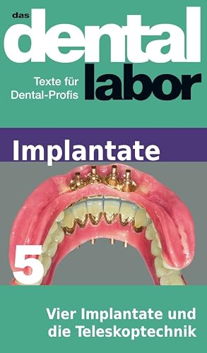 Vier Implantate und die Teleskoptechnik (das dental labor Fachtexte 25)