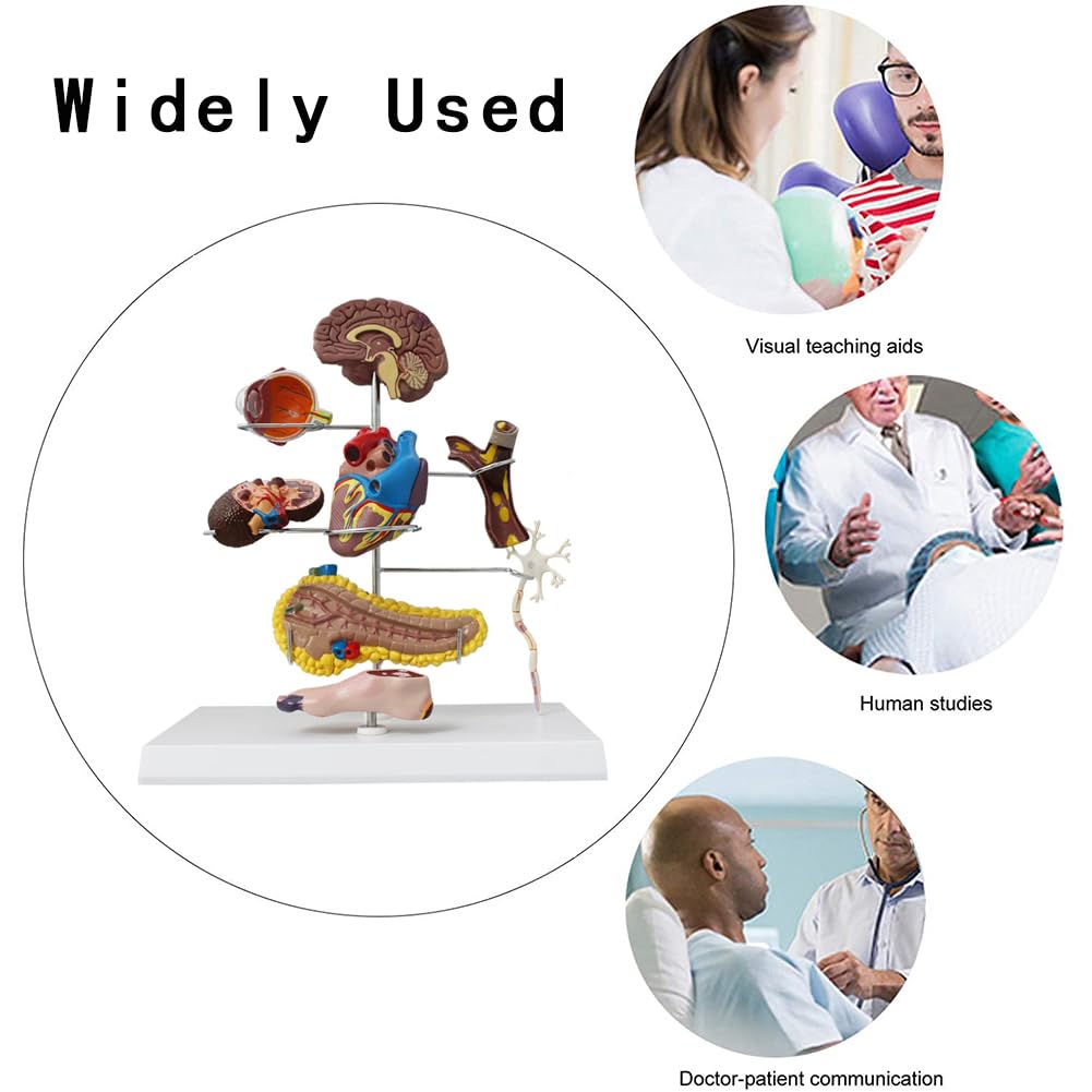 Medyczny Model Cukrzycy, Model Patologii Cukrzycy, Materiał PVC Patologia Cukrzycy Serce, 8 Części Zdejmowany Model Narządu Dla Studentów Anatomii I Fizjologii
