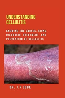 UNDERSTANDING CELLULITIS: KNOWING THE CAUSES, SIGNS, DIAGNOSIS, TREATMENT, AND PREVENTION OF CELLULITIS
