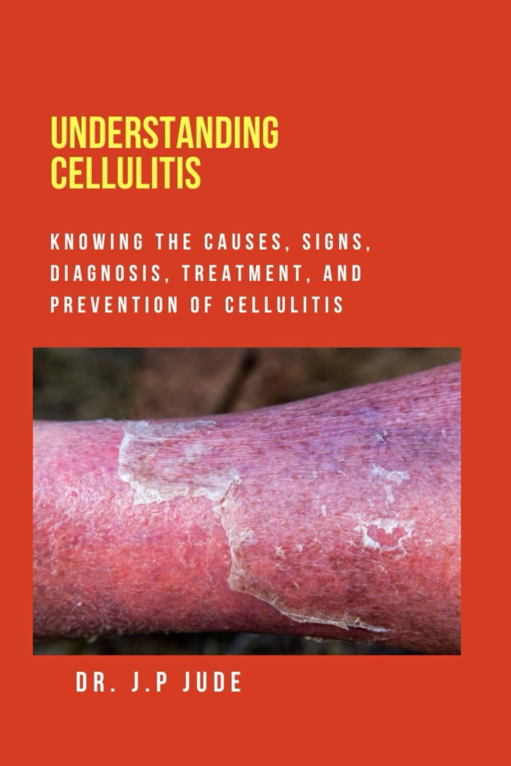 UNDERSTANDING CELLULITIS: KNOWING THE CAUSES, SIGNS, DIAGNOSIS, TREATMENT, AND PREVENTION OF CELLULITIS