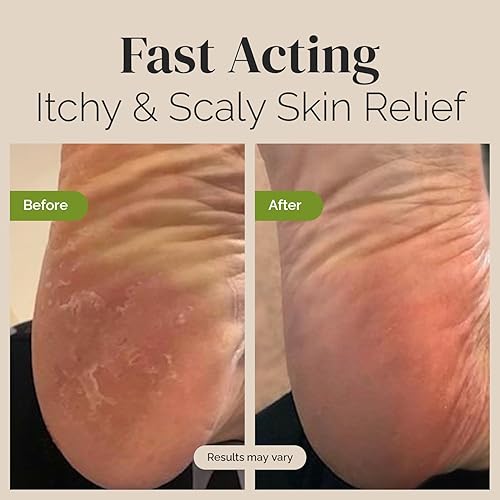 Miniatura 3 de Puriya Juego de bálsamo de aceite de árbol de té y gel de baño para hombres, mujeres, jabón extra fuerte formulado por médicos, aprobado por