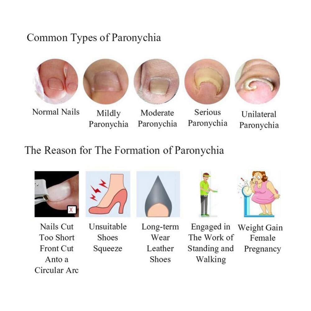 Pincer Nail Vs Ingrown Nail ubicaciondepersonas.cdmx.gob.mx