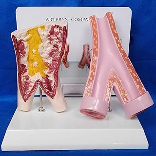 Educational Model Comparison Model Between Smoking Blood Vessels and Normal Blood Vessels - Anatomical Blood Model Human Organs Anatomical Model - for Study Display Teaching Medical Model