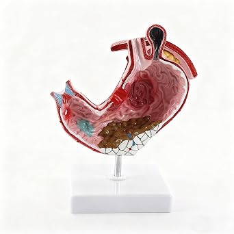 Human Pathological Stomach Model with Base, Detachable Anatomical Model for Gastric Ulcer Chronic Atrophic Gastritis Demonstration, Stomach Lesion Visual Aid Tool