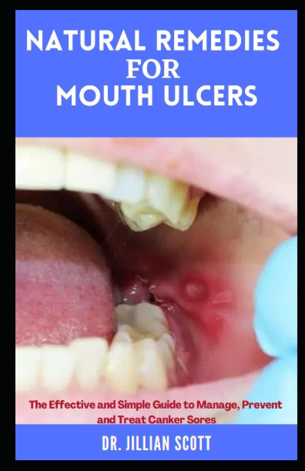 Buy Natural Remedies for Mouth Ulcers An Effective and Simple Guide to