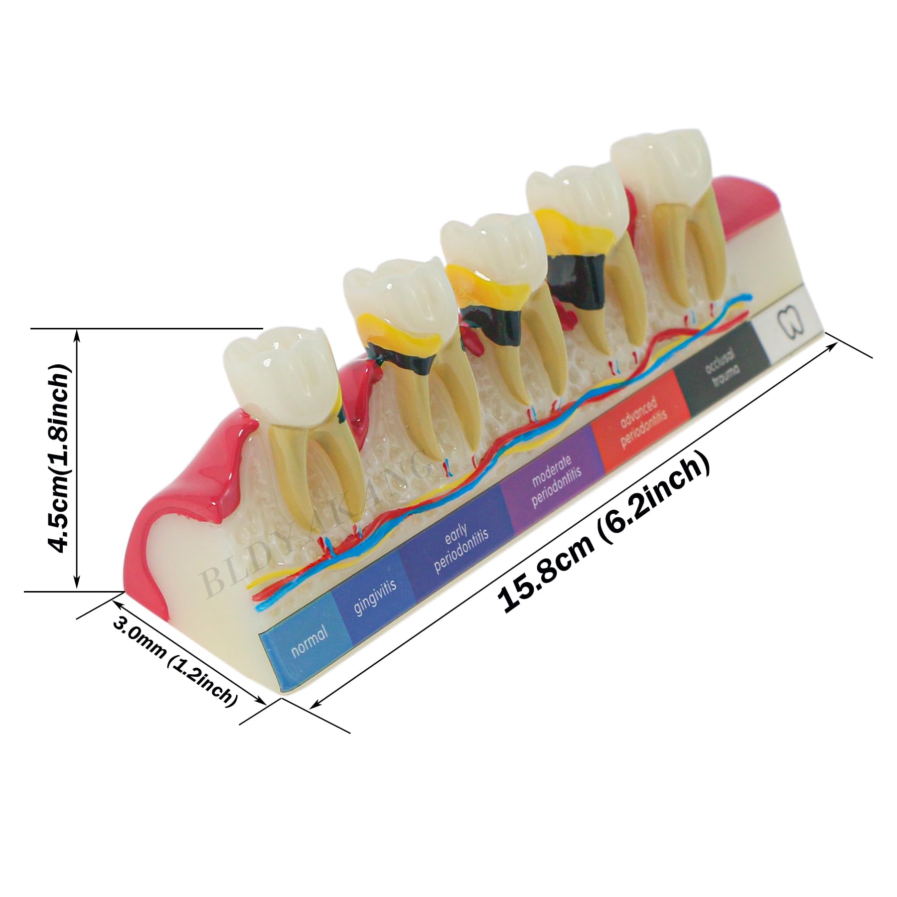 Dental Typodont Periodontal Disease Dental Caries Developing Model Dental Teeth Model for Dental Tooth Anatomy Study Doctor-Patient and Oral Care Education (M4026 Periodontal Disease Teeth Model)