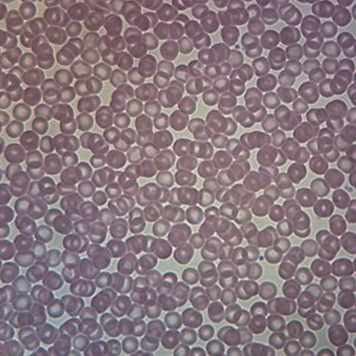 Human Iron Deficiency Anemia, Smear Microscope Slide