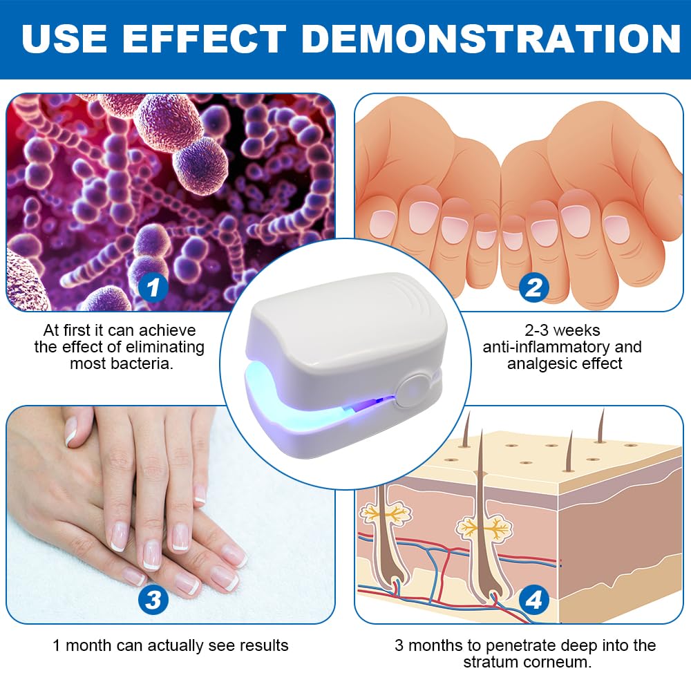 Dispositivo per Terapia con Luce per Funghi Delle Unghie, Fungo Delle Unghie, Fototerapia Fungo, per Terapia Laser a Freddo Portatile, per la Pulizia e la Cura Delle Unghie