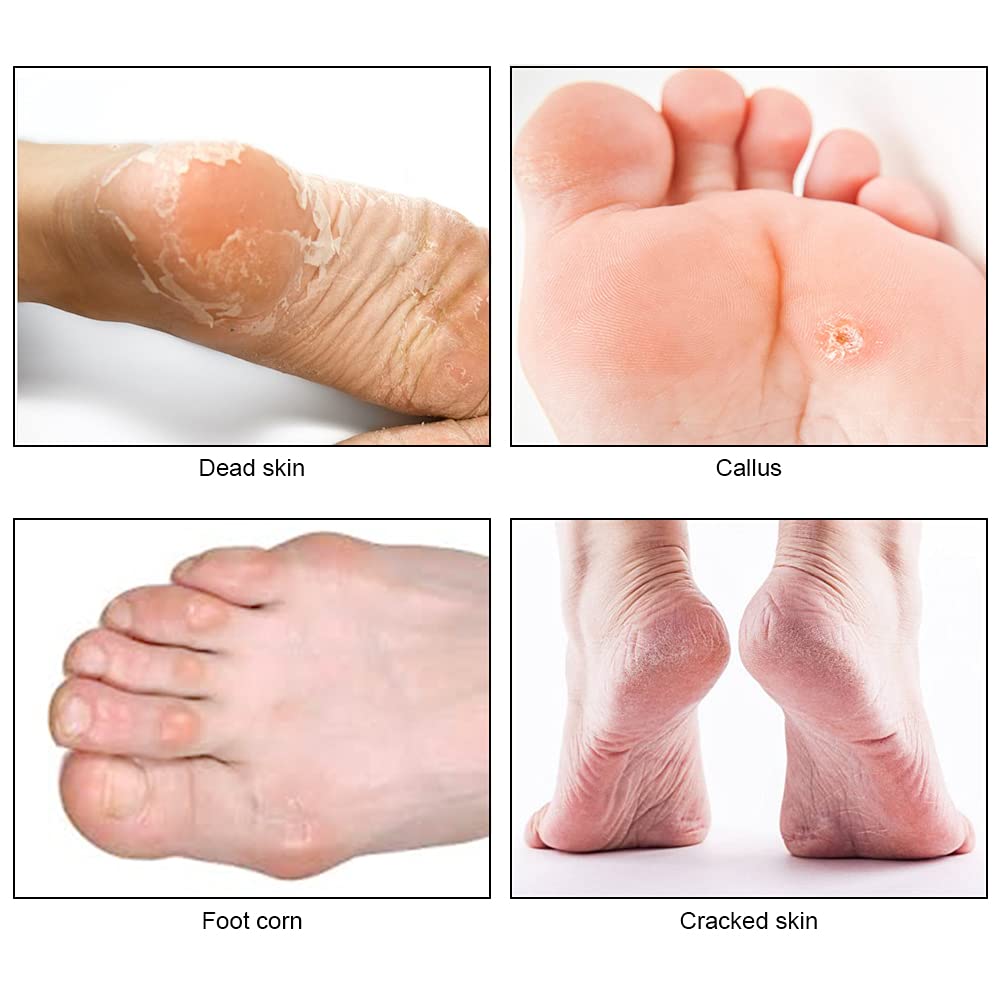 URAQT Eliminador de Callos y Callosidades, Raspador de Pies con 10 Cuchillas, Lima de Callos Remover la Piel Muerta, Removedor de Callos de Acero Inoxidable para el Cuidado de los Pies en Hogar