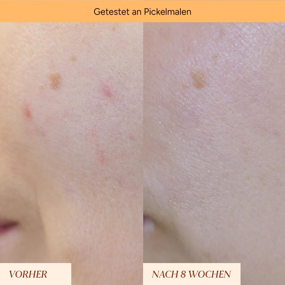 JUNGLÜCK Anti Pigment Spots & Pimple Marks Roll-On - Vegan, orange, 5 ml (Pack of 1) - Image 3