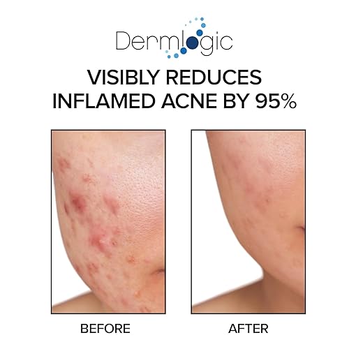 Miniatura 6 de Almohadillas de tratamiento para el acné: contiene ácido salicílico, glicólico y láctico para la cara y el cuerpo. Limpia los poros obstruidos, la