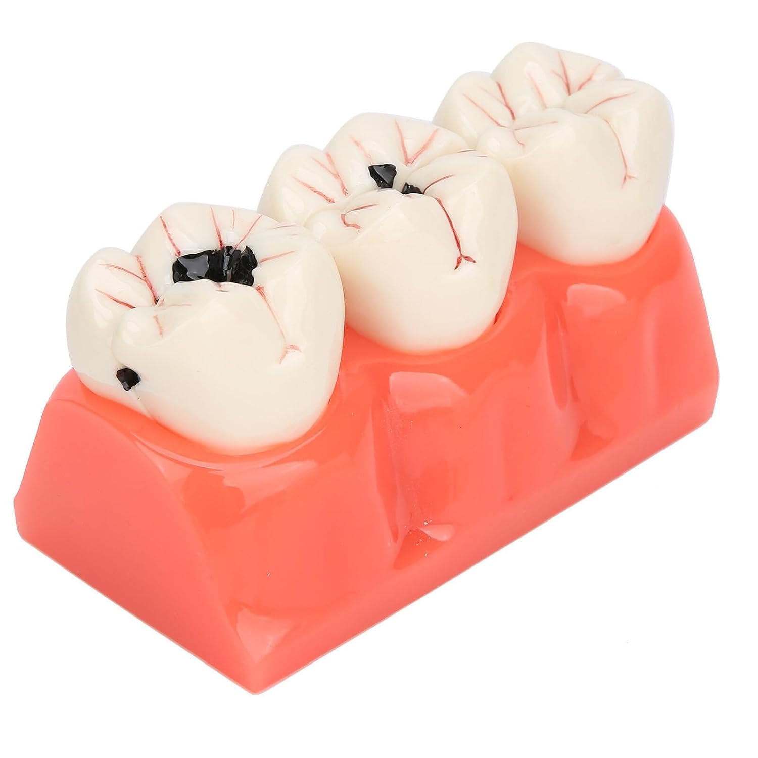 4 Times Caries Evolution Model Detachable Teeth Disease Teach Anatomy Model for Dentist Teaching Learning