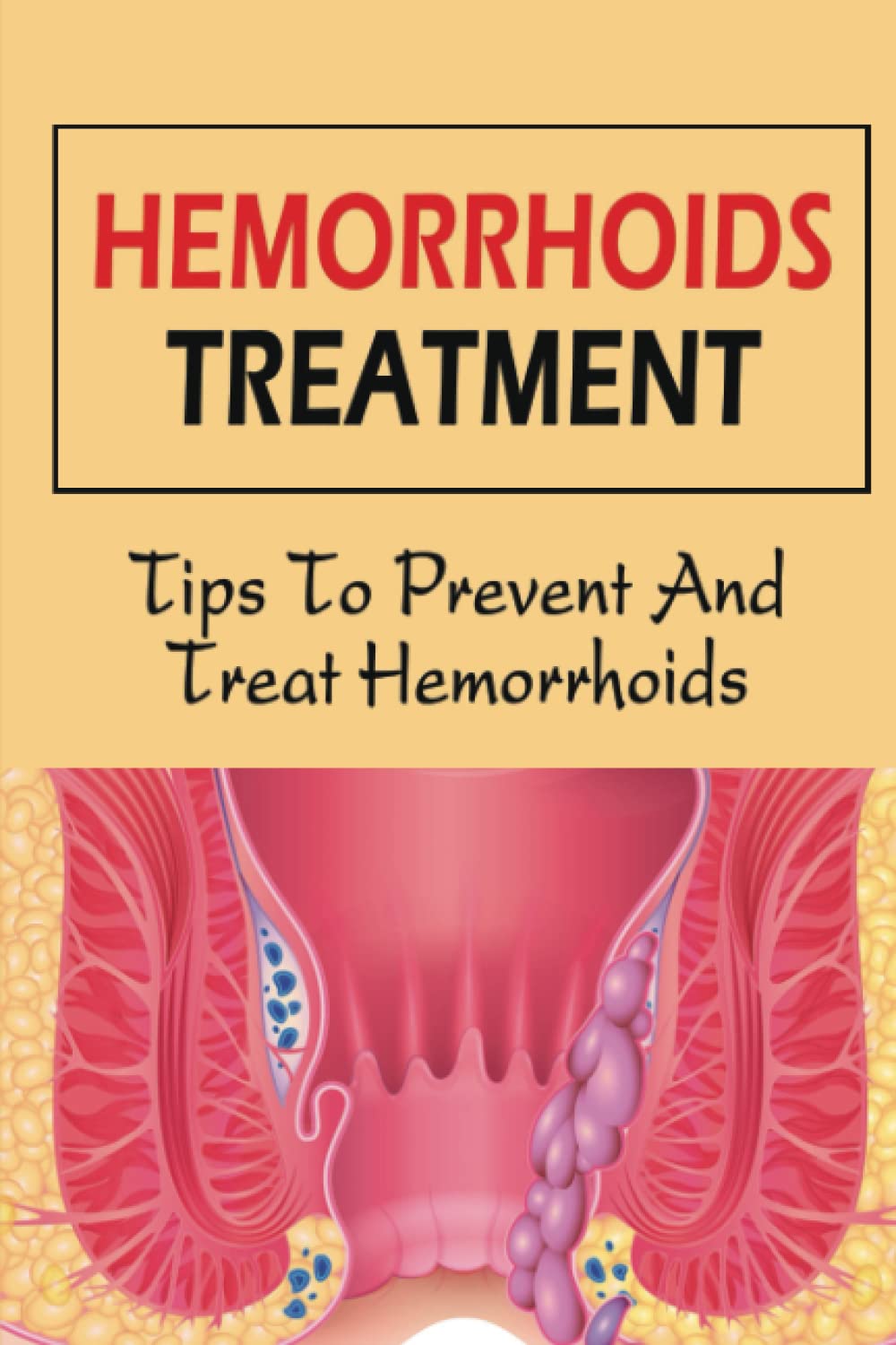 Hemorrhoids Treatment: Tips To Prevent And Treat Hemorrhoids