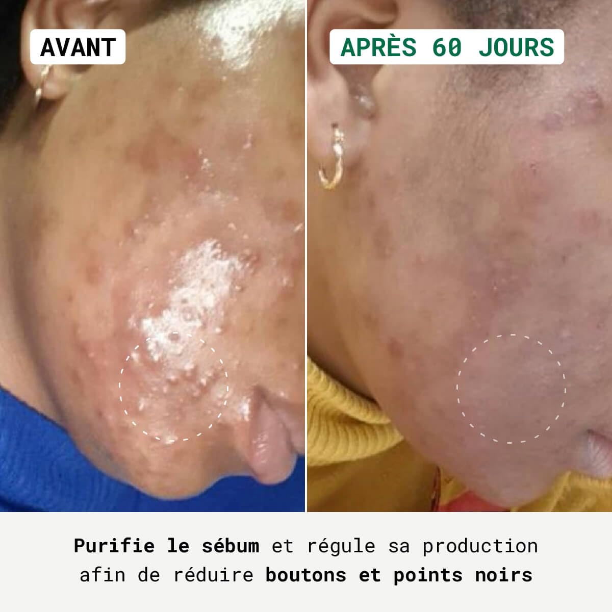 Nubiance Coffret Soin Visage Acné, Anti Point Noir, Peaux Mixtes