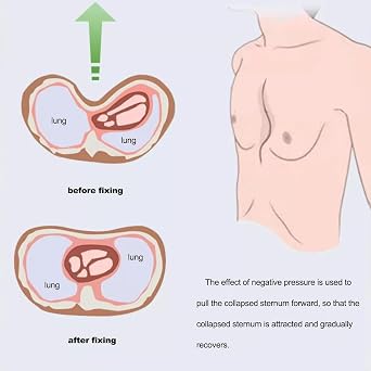 Pectus Excavatum Vacuum Bell Orthosis Brace with Real-Time Monitoring Pressure Gauge - Washable Physical Correction Device